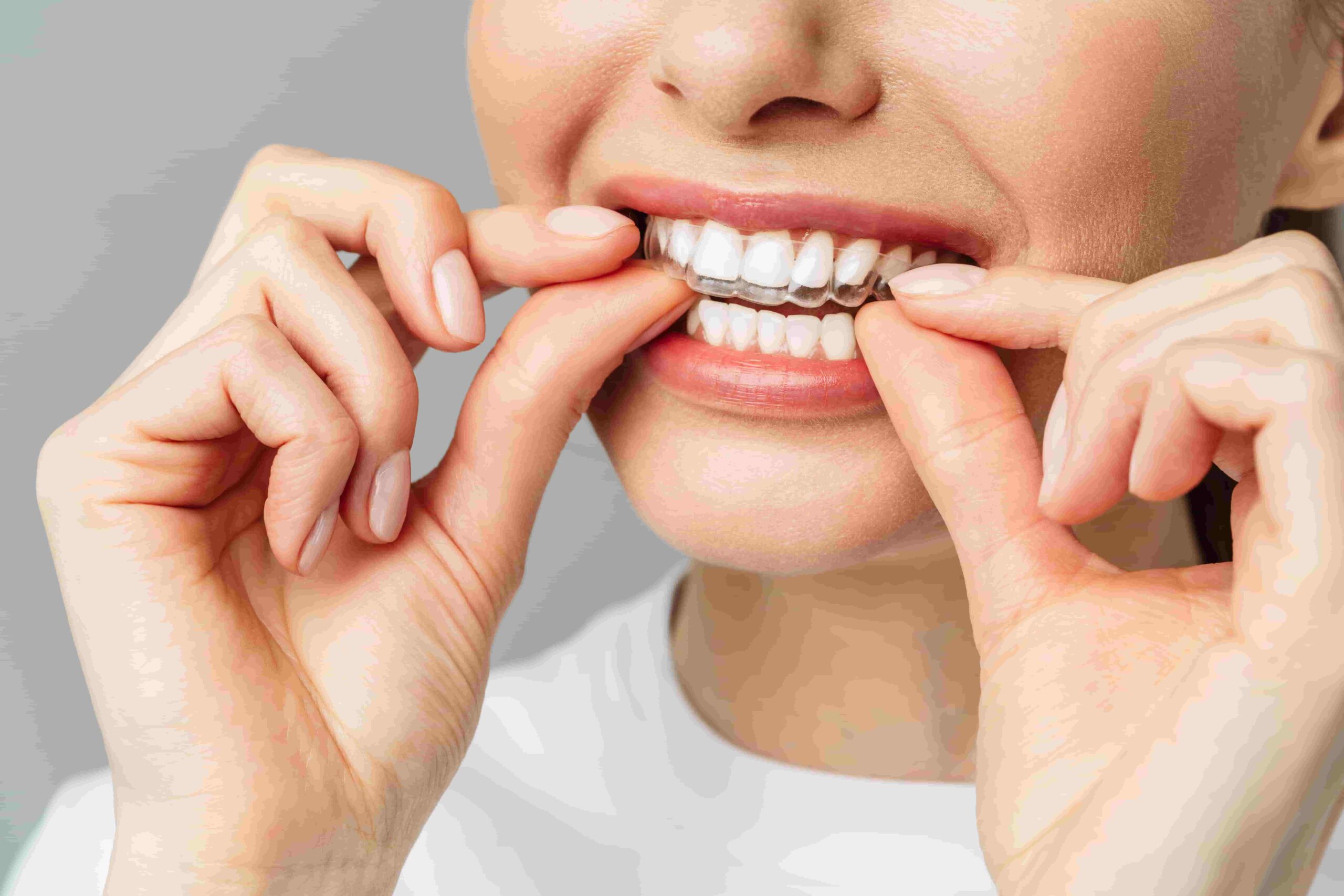 Orthodontie discrète : Les gouttières invisibles près de Reims.